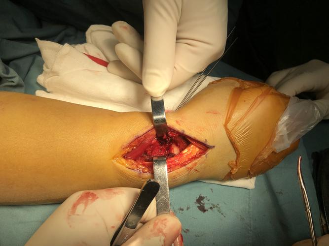 写美篇 分享一例粉碎的桡骨远端骨折手术,运用掌背侧联合入路进行复位