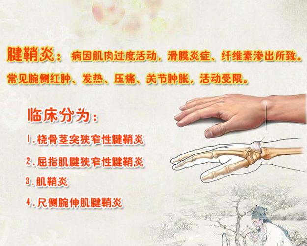 尺侧腕伸肌腱鞘炎,在腕部活动度过大时,因反复牵拉或扭伤,可诱发腕尺