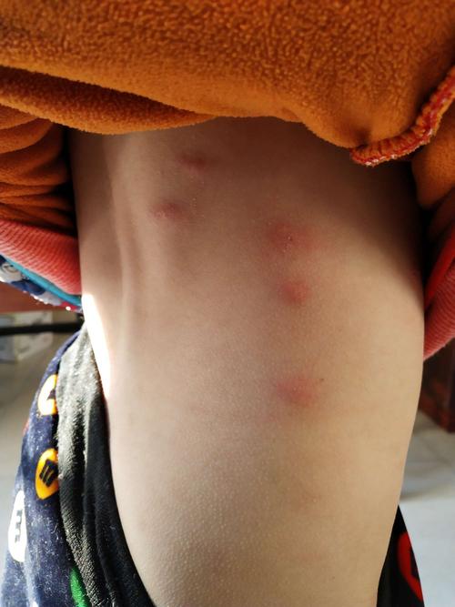 丘疹性荨麻疹又叫虫咬皮炎,这些都是虫咬的,虫咬的!