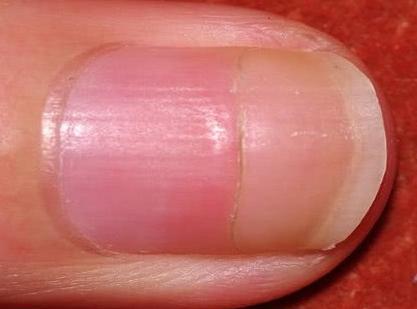 肝癌患者已近百万,不论男女,指甲3种"迹象"八成肝已"