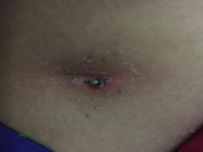 我刚做完腹腔镜手术13天,手有点欠,伤口一痒挠破了,不