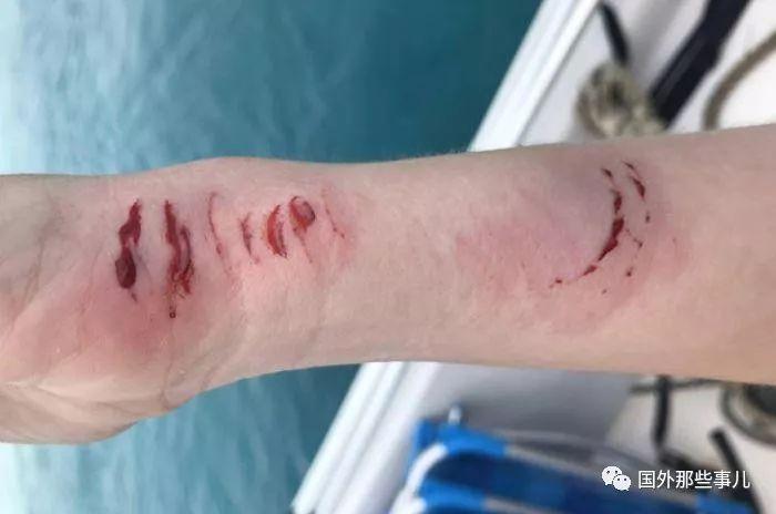比基尼美女和鲨鱼同游 不幸被咬伤