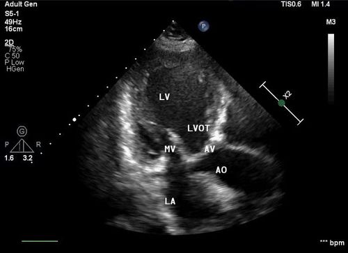 超声心动图看不懂?从原理到检验单数值一文理清!丨内附动图视频