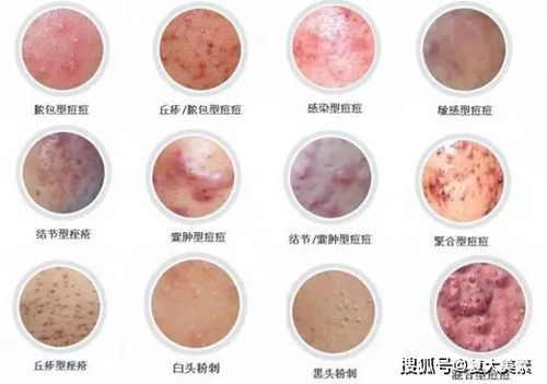 进阶的情况则是脓包型痘痘,囊肿型痘痘,丘疹型痘痘等.