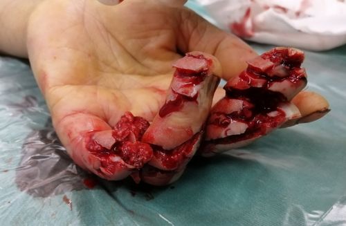 术后一周中指皮肤感染伴坏死,予以清创换药,感染控制后予以双y—y推进