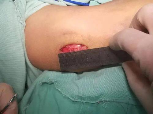 常规手术治疗为尺神经松解前置术,手术切口常规15-20cm,外形不美观