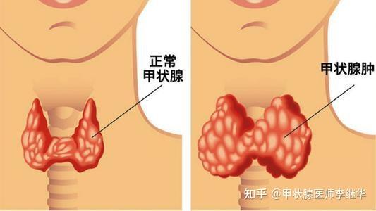 甲状腺肿大吗甲状腺大小正常范围是多少甲状腺肿大如何饮食