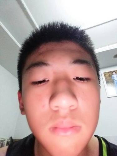 男生15岁额头抬头纹位置中央有一条横着凹进去的窝,能