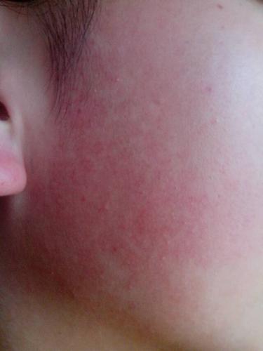 我的脸两侧几年前被太阳晒伤,留下斑,动不动就发