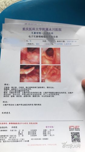 声带息肉应该怎么处理呢,各位给给意见