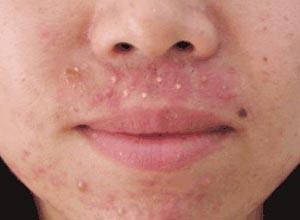 以脓疮表现为主,脓疱为谷粒至绿豆大小,为毛囊性脓疱和丘疹顶端形成