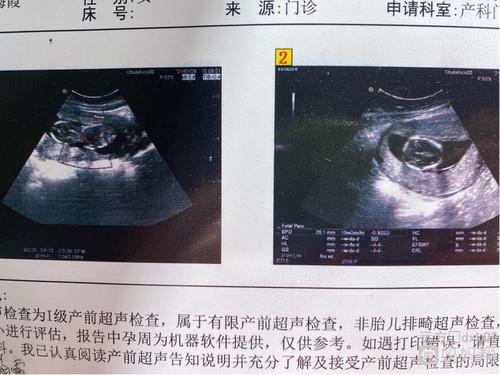 怀孕十五周一,做的无创拍的彩超,据说看