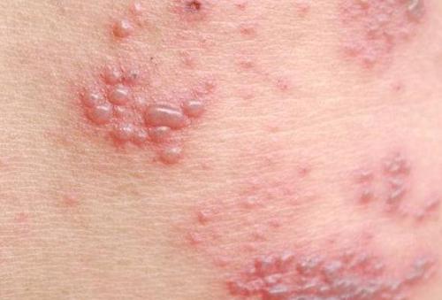 所谓的"缠腰蛇",其实就是"带状疱疹"!5类人易高发,需警惕