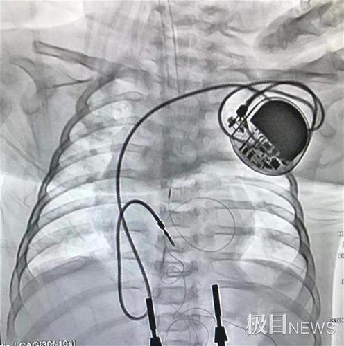 心跳太缓慢,4个月"先心病"宝宝植入永久性心脏起搏器