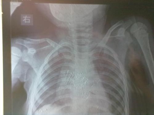 宝宝五岁了右侧锁骨骨折只是简单固定可以吗?