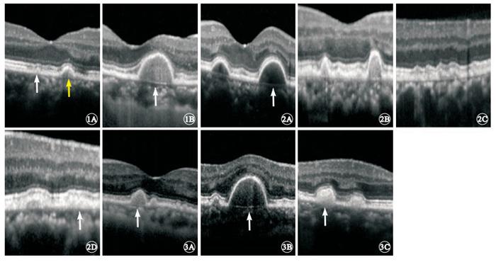 萎缩型老年性黄斑变性玻璃膜疣的频域光相干断层扫描图像特征