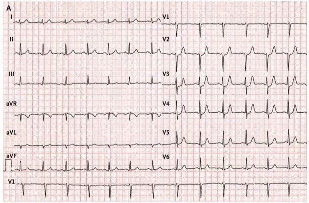 被航天中心医院赵运涛在nejm发表的一篇缺血心电图刷屏了这里有他更