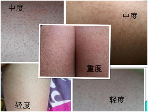 鸡皮肤的形成原因 都了解这么清楚了不信去不掉