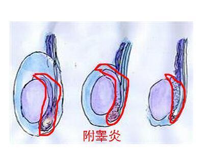 附睾炎有哪些危害