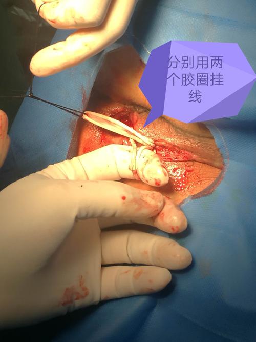 炎性肠病伴肛瘘(半马蹄型肛瘘)手术,术者秦澎湃