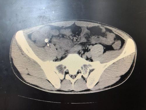 跑进阑尾里的粪石!