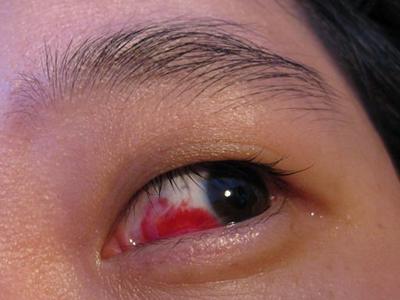 眼睛充血是不是疾病 怎么治疗