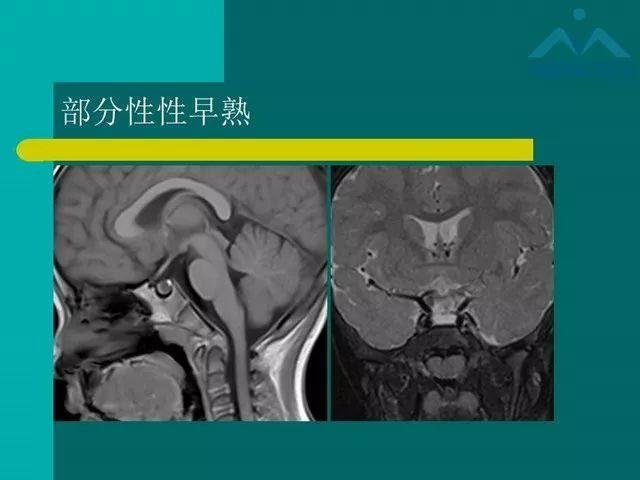儿童rathke裂囊肿的影像与临床 | 影像天地
