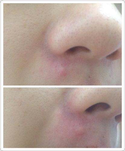 这种是不是叫增生疤(那里以前是个痣),凸起的一块,去医院有办法去掉吗