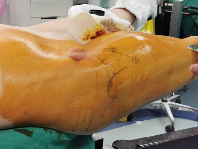 0603髋关节镜手术…吴关