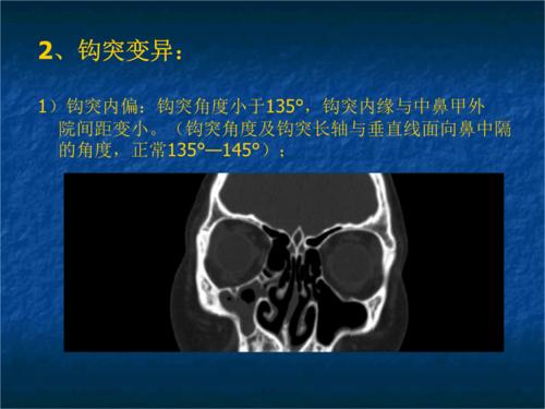 窦口-鼻道复合体.ppt