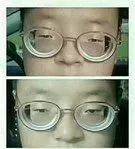 高度近视后眼睛变形,相貌变丑,感觉和周围世界格格不入,羡慕那些