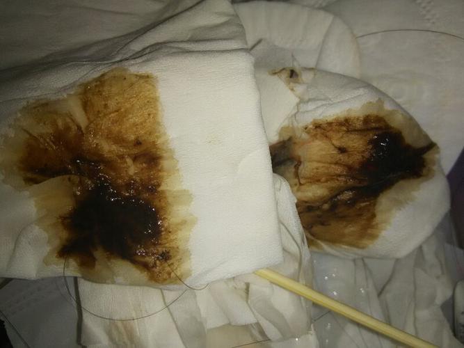 请问妇科方面的医生轻度的宫颈糜烂上完药之后白带怎么变成这样的了