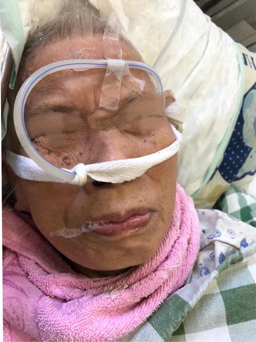 不仅拔除长期置留的鼻胃管,部分患者甚至已经能自行经口进食