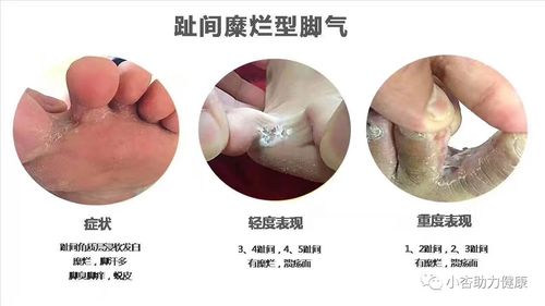 脚气的治疗对比