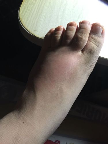 左脚中间三趾动不了,脚面和脚底红肿,无痛感.突然就这样了.