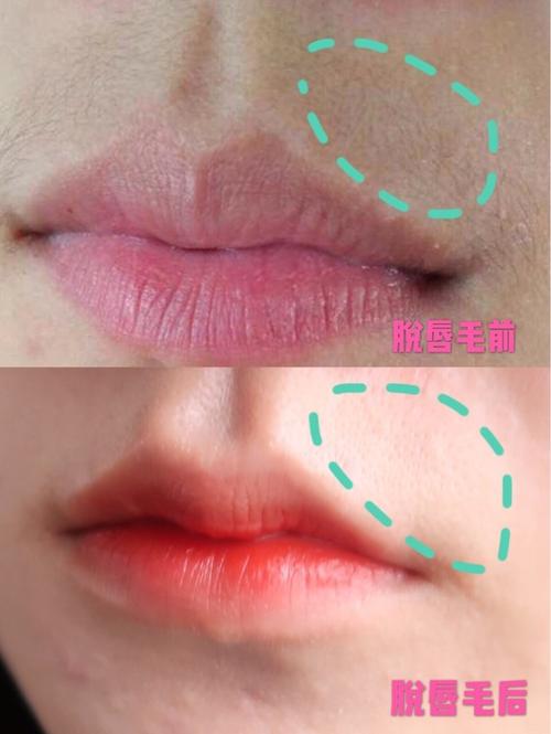 告别难看小胡子—激光脱唇毛来帮你02告别了青春期