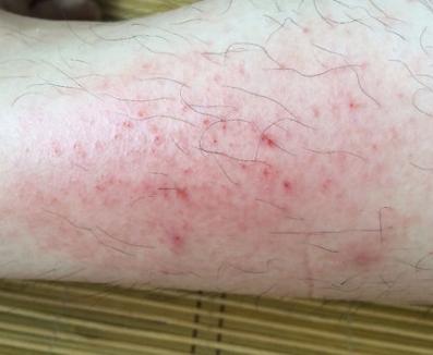 接触性皮炎症状,看完让你比专家懂得还多