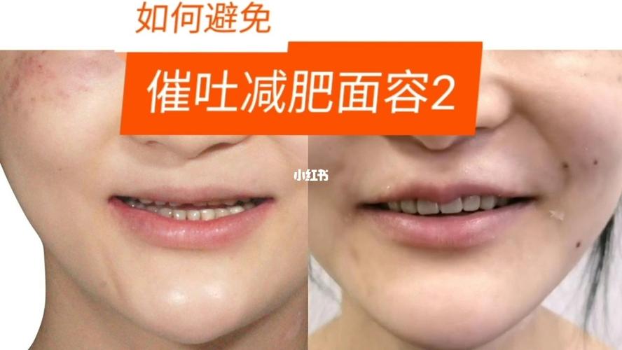 暴食催吐会变丑,做好以下三点提升颜值_胃酸_牙医_正畸_隐适美怎么样