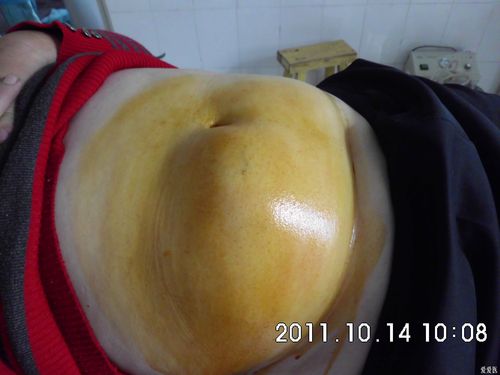 典型腹壁脂肪瘤超声及手术标本图----------谨以此片献给刚入门的爱友