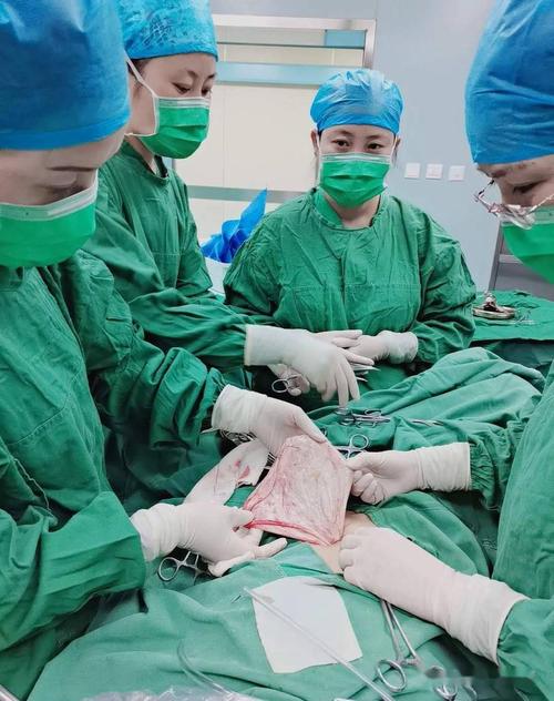 【动·态】我院完成首例经脐单孔腹腔镜巨大卵巢囊肿剔除术