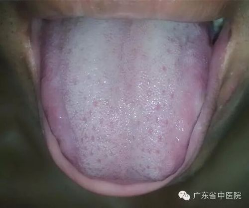 流清鼻涕,咽痛发痒,咳嗽出白稀痰的话,这就是中医所说的"风寒感冒"外