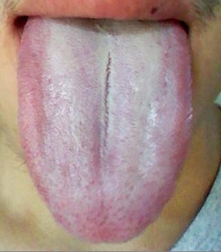 舌苔很白怎么办?是什么原因引起的