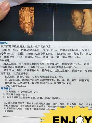 四维发现唇裂_四维彩超_双胞胎_母婴_孕产经验