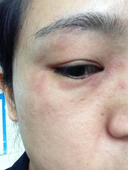 眼睛周围皮肤有一块块红点,是怎么回事啊?过敏?