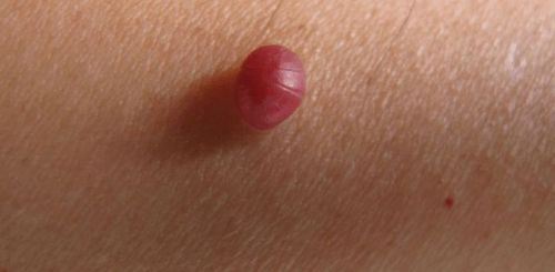 樱桃状血管瘤好发于30岁以上中老年人无传染性病因尚不明确