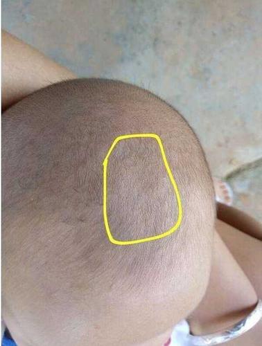 三个月宝宝前囟门鼓起囟门4cm7245cm头围约397cm精神及状态正常请问