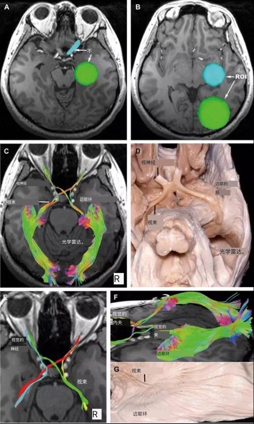 a,感兴趣区选在冠状位嗅神经束;b,高分辨率示踪嗅神经;c,对应的解剖