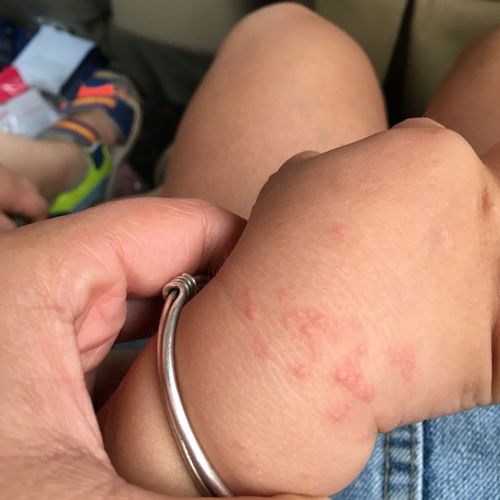 不知道是不是这几天带宝宝去玩沙子(说是决明子)过敏了