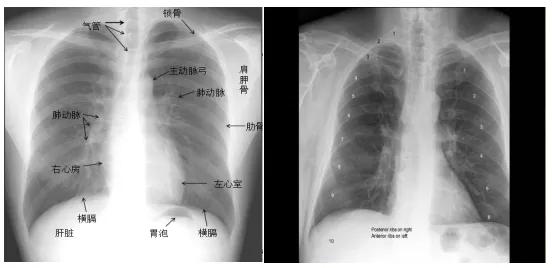 "0"基础小白必备宝典:认识肺部影像结构