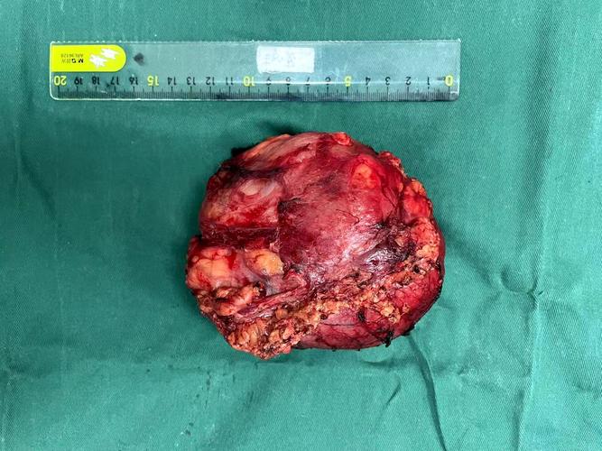 其占全部恶性肿瘤不到1%,但在原发性腹膜后软组织肉瘤中却是最常见的